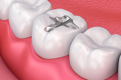 The image shows a close-up of a dental implant integrated into a human tooth, set against the backdrop of a healthy oral cavity with visible gums and teeth.