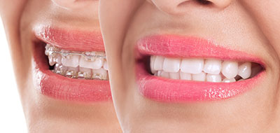 The image is a split-screen photo of a person s face with two different expressions. On the left side, the person is smiling with their mouth open, showcasing white teeth and pink lipstick. On the right side, the same person appears to be frowning or making a displeased expression with their lips closed, also revealing white teeth and pink lipstick.