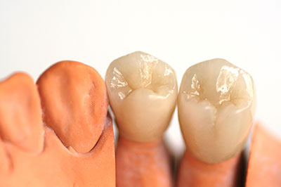 The image shows a set of artificial teeth with varying shades and textures, displayed against a white background.