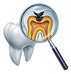 An illustration of a magnified tooth with an internal view showing the pulp chamber and root canals, with a dental probe pointing at it.