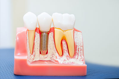 Dental implants with screws and a model of a mouth in a pink holder, showcasing dental prosthetics.