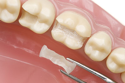 The image shows a close-up of a dental implant being placed into a tooth socket, with a small piece of bone graft material visible between the implant and the socket.