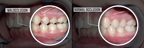 An image of a dental procedure, showing before and after states with text labels indicating  Malocclusion  and  Normal occlusion , highlighting the transformation in tooth alignment.