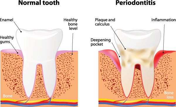 The image is a medical illustration showing the stages of tooth decay progressing from normal to periodontitis, with labels indicating bone loss and infection.