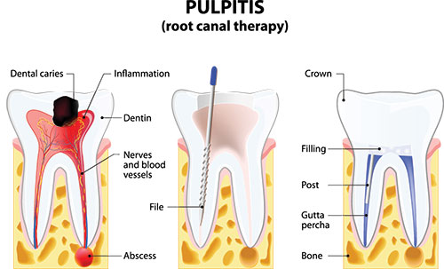 The image is a diagrammatic illustration of the pulpitis process in teeth, showing the tooth with inflammation and infection in the pulp chamber, along with annotations indicating dental caries, inflammation, and a blue highlight on the affected area.