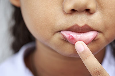 A young child with a pimple on their chin, examining it closely with their finger.