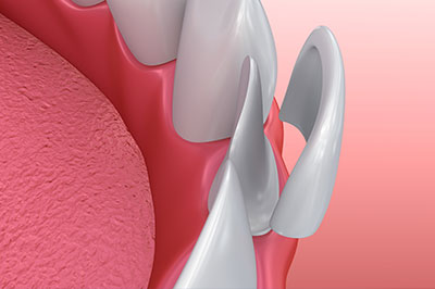 The image shows a close-up of a dental implant with a screw visible, set against a pink background that appears to be a representation of gum tissue.