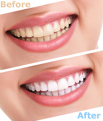 The image is a collage of three photos showing a person s smile before and after dental treatment, highlighting the results of teeth whitening.