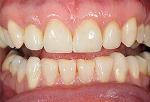 An image of a person s teeth, showing yellowing and discoloration.