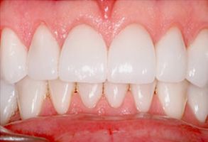 The image shows a close-up of a person s teeth with a focus on the upper front teeth, which appear to be in need of dental care due to their discoloration and possible decay.