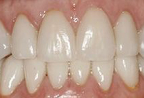 The image displays a close-up of a person s teeth, showcasing the upper front teeth with a focus on their condition and appearance.
