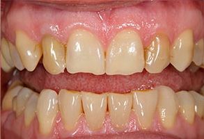 The image shows a close-up of a person s teeth with a focus on the lower front teeth, which appear to be yellowed and possibly in need of dental care.
