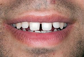 A man s smiling face with a missing tooth, showcasing dental imperfections.