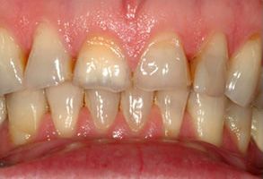 The image shows a close-up of a person s teeth with yellowing and staining, indicating poor oral hygiene or dental issues.