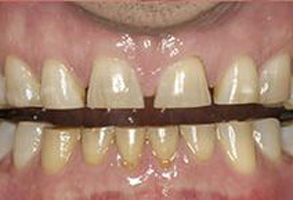 A close-up image of a person s teeth with visible staining and yellowing, showcasing dental decay.